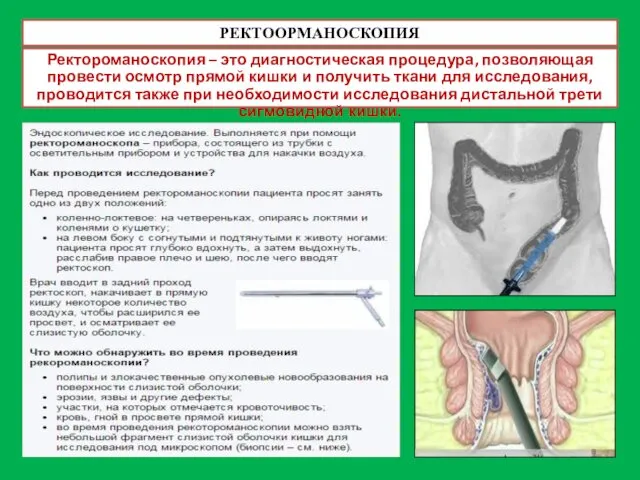 РЕКТООРМАНОСКОПИЯ Ректороманоскопия – это диагностическая процедура, позволяющая провести осмотр прямой