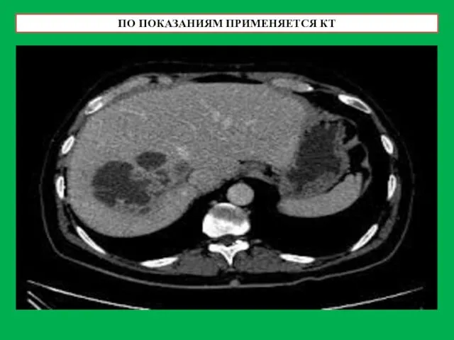 ПО ПОКАЗАНИЯМ ПРИМЕНЯЕТСЯ КТ