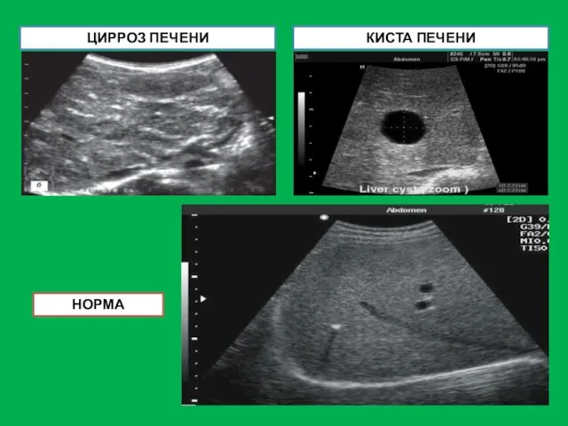 КИСТА ПЕЧЕНИ ЦИРРОЗ ПЕЧЕНИ НОРМА