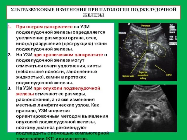 УЛЬТРАЗВУКОВЫЕ ИЗМЕНЕНИЯ ПРИ ПАТОЛОГИИ ПОДЖЕЛУДОЧНОЙ ЖЕЛЕЗЫ При остром панкреатите на