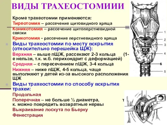 ВИДЫ ТРАХЕОСТОМИИИ Кроме трахеотомии применяются: Тиреотомия – рассечение щитовидного хряща