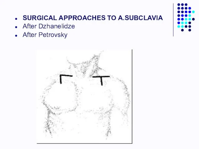 SURGICAL APPROACHES TO A.SUBCLAVIA After Dzhanelidze After Petrovsky