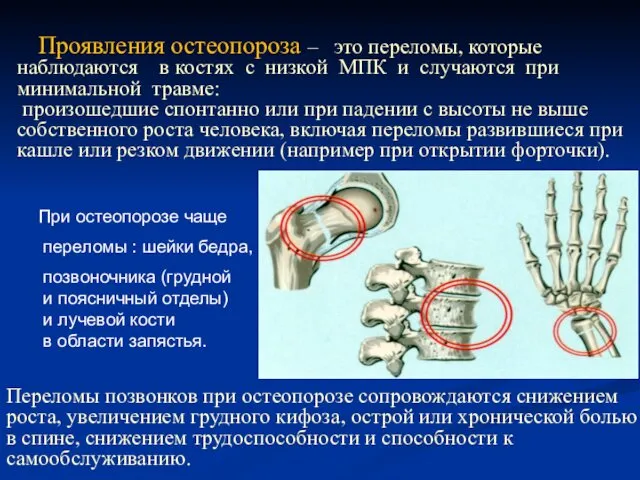 При остеопорозе чаще переломы : шейки бедра, позвоночника (грудной и