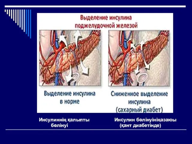 Инсулиннің қалыпты бөлінуі Инсулин бөлінуініңазаюы (қант диабетінде)