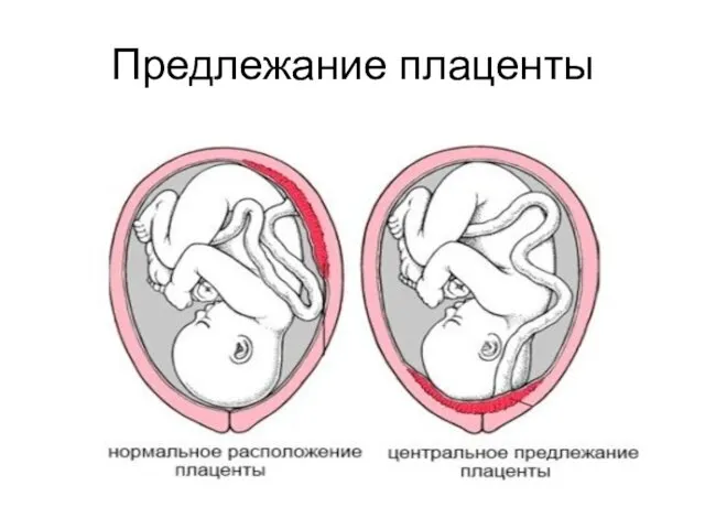 Предлежание плаценты