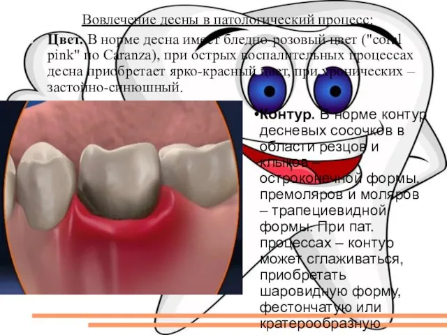 Вовлечение десны в патологический процесс: Цвет. В норме десна имеет