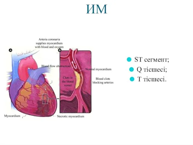 ИМ ST сегмент; Q тісшесі; T тісшесі.