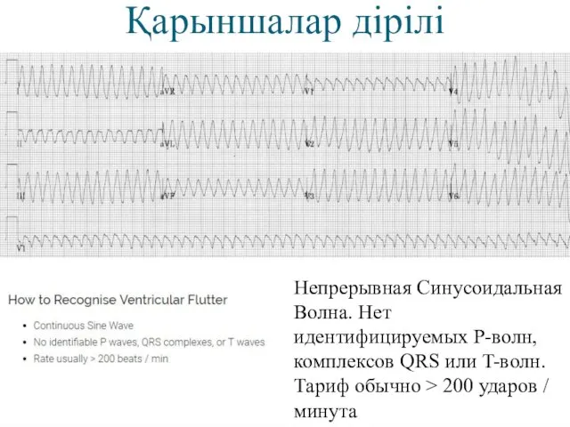 Қарыншалар дірілі Непрерывная Синусоидальная Волна. Нет идентифицируемых P-волн, комплексов QRS