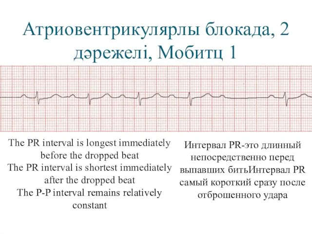 Атриовентрикулярлы блокада, 2 дәрежелі, Мобитц 1 The PR interval is