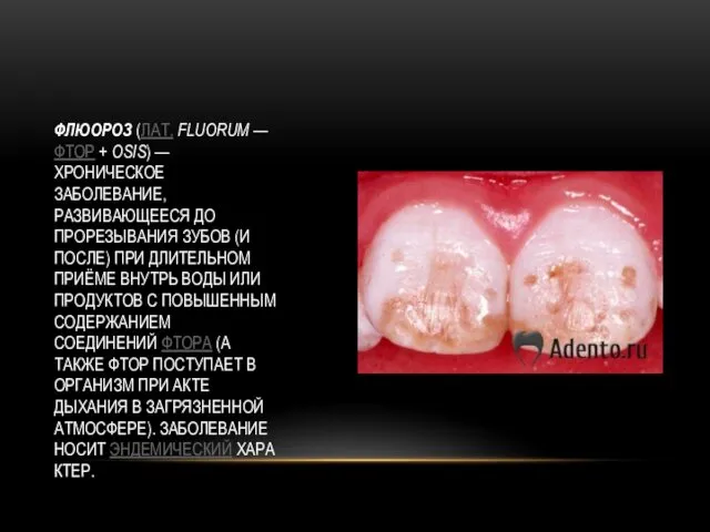 ФЛЮОРОЗ (ЛАТ. FLUORUM — ФТОР + OSIS) — ХРОНИЧЕСКОЕ ЗАБОЛЕВАНИЕ,