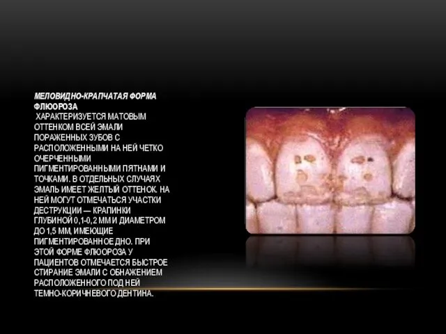 МЕЛОВИДНО-КРАПЧАТАЯ ФОРМА ФЛЮОРОЗА ХАРАКТЕРИЗУЕТСЯ МАТОВЫМ ОТТЕНКОМ ВСЕЙ ЭМАЛИ ПОРАЖЕННЫХ ЗУБОВ