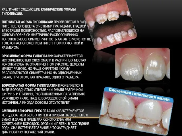 РАЗЛИЧАЮТ СЛЕДУЮЩИЕ КЛИНИЧЕСКИЕ ФОРМЫ ГИПОПЛАЗИИ. ПЯТНИСТАЯ ФОРМА ГИПОПЛАЗИИ ПРОЯВЛЯЕТСЯ В