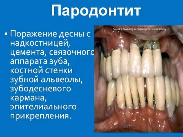 Пародонтит Поражение десны с надкостницей, цемента, связочного аппарата зуба, костной