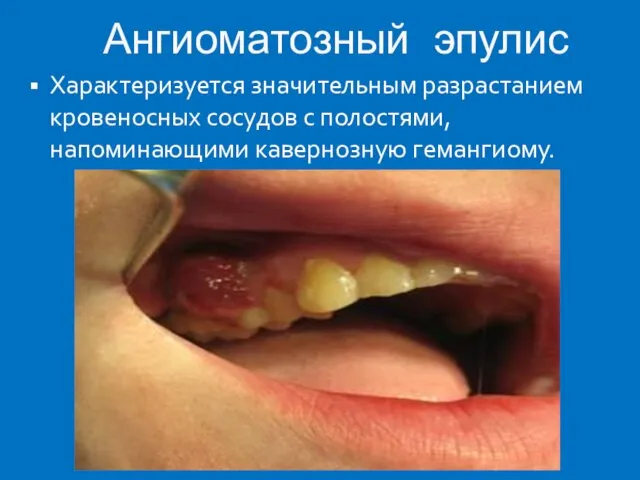 Ангиоматозный эпулис Характеризуется значительным разрастанием кровеносных сосудов с полостями, напоминающими кавернозную гемангиому.