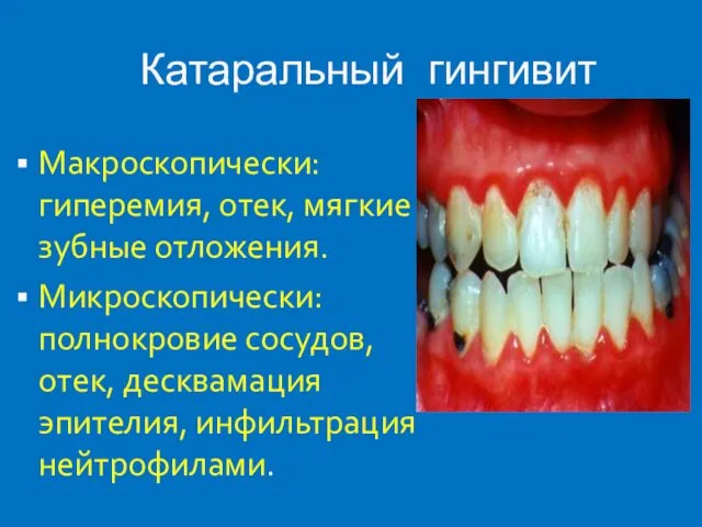 Катаральный гингивит Макроскопически: гиперемия, отек, мягкие зубные отложения. Микроскопически: полнокровие сосудов, отек, десквамация эпителия, инфильтрация нейтрофилами.