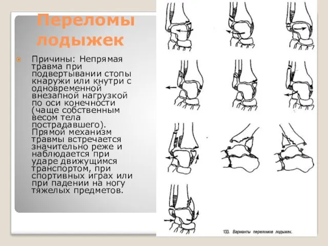 Переломы лодыжек Причины: Непрямая травма при подвертывании стопы кнаружи или