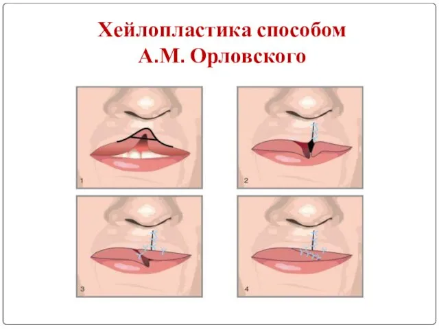 Хейлопластика способом А.М. Орловского