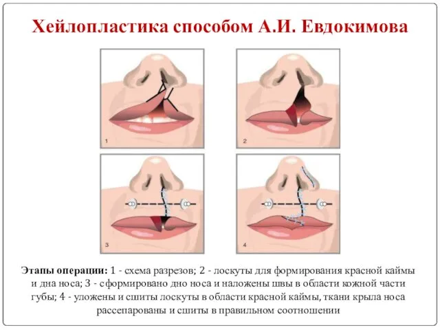 Хейлопластика способом А.И. Евдокимова Этапы операции: 1 - схема разрезов;