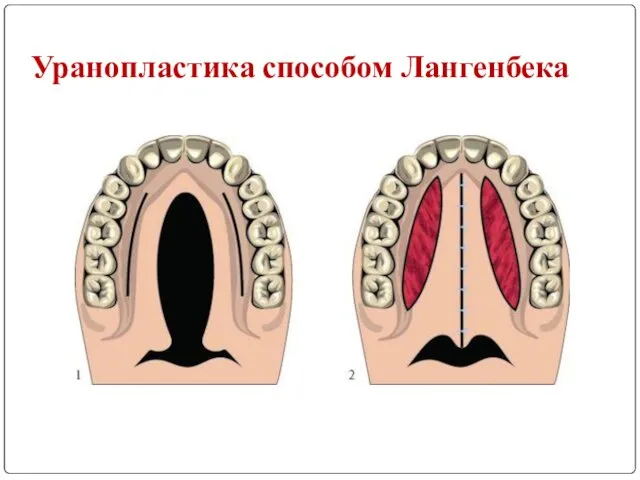 Уранопластика способом Лангенбека