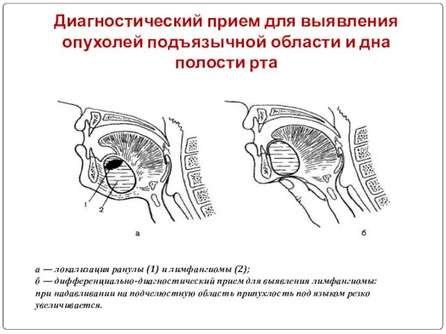 Диагностический прием для выявления опухолей подъязычной области и дна полости