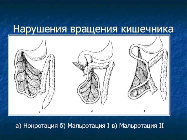 Нарушения вращения кишечника а) Нонротация б) Мальротация I в) Мальротация II