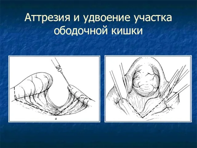 Аттрезия и удвоение участка ободочной кишки