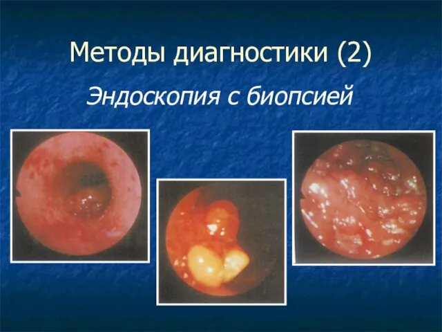 Методы диагностики (2) Эндоскопия с биопсией