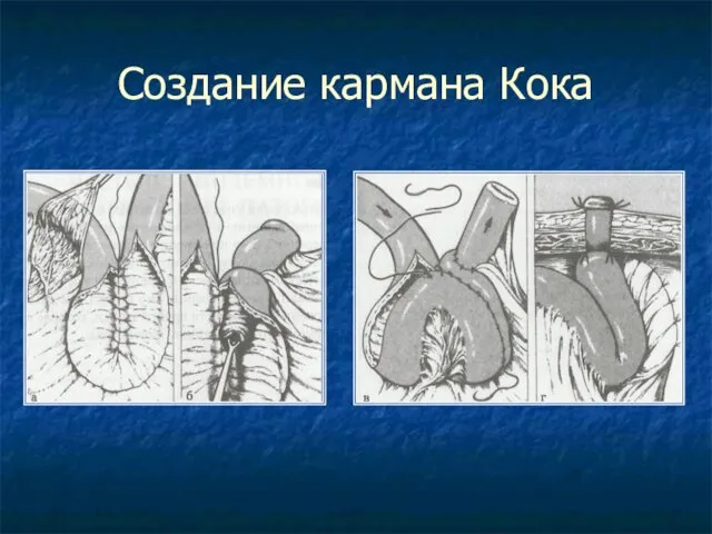 Создание кармана Кока