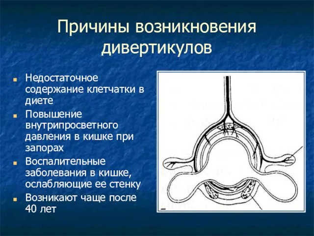 Причины возникновения дивертикулов Недостаточное содержание клетчатки в диете Повышение внутрипросветного