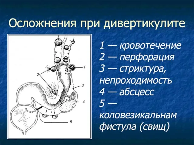 Осложнения при дивертикулите 1 — кровотечение 2 — перфорация 3