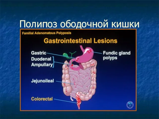 Полипоз ободочной кишки