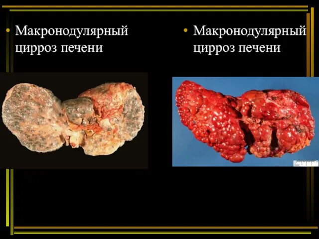 Макронодулярный цирроз печени Макронодулярный цирроз печени