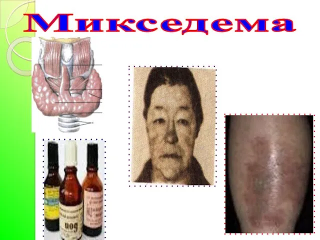 Микседема