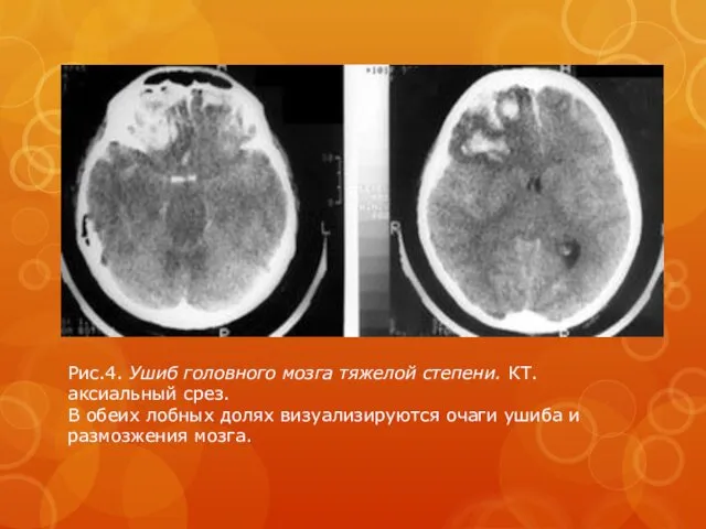 Рис.4. Ушиб головного мозга тяжелой степени. КТ. аксиальный срез. В