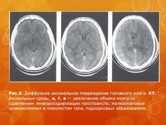 Рис.6. Диффузное аксональное повреждение головного мозга. КТ. Аксиальные срезы, а,