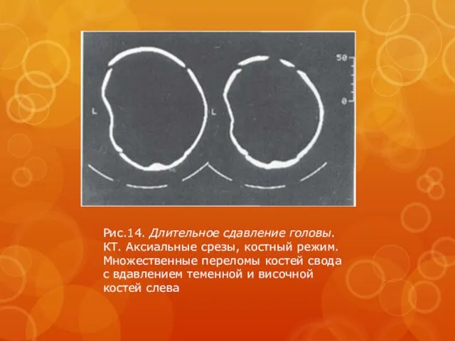 Рис.14. Длительное сдавление головы. КТ. Аксиальные срезы, костный режим. Множественные