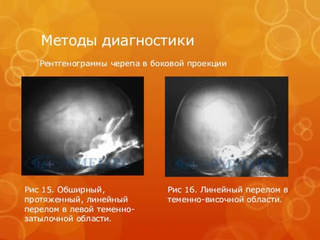 Методы диагностики Рентгенограммы черепа в боковой проекции Рис 15. Обширный,