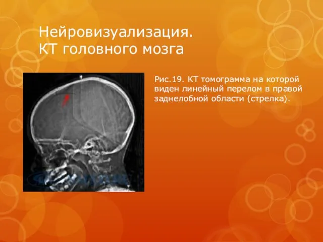 Нейровизуализация. КТ головного мозга Рис.19. КТ томограмма на которой виден
