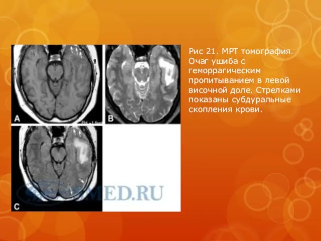 Рис 21. МРТ томография. Очаг ушиба с геморрагическим пропитыванием в