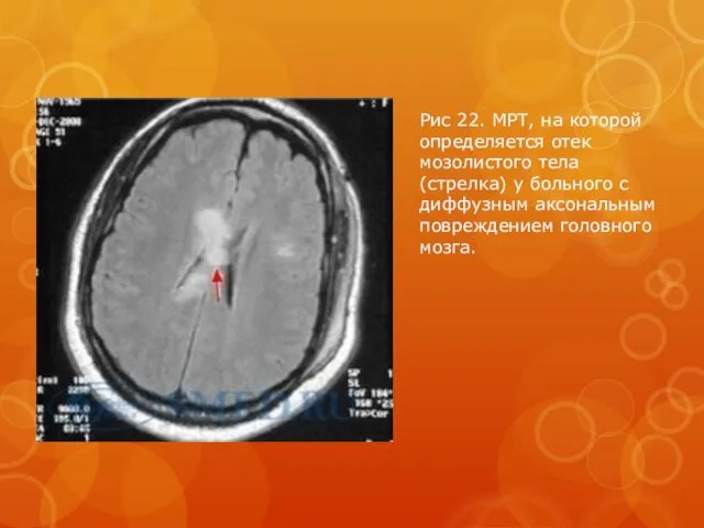Рис 22. МРТ, на которой определяется отек мозолистого тела (стрелка)
