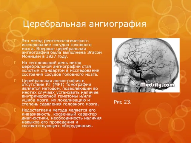 Церебральная ангиография Это метод рентгенологического исследование сосудов головного мозга. Впервые