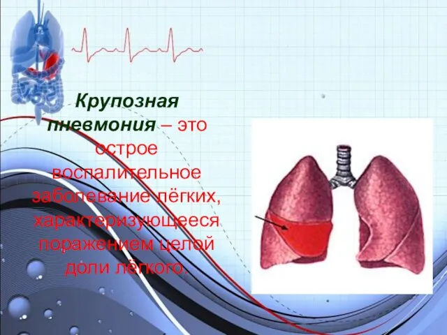 Крупозная пневмония – это острое воспалительное заболевание лёгких, характеризующееся поражением целой доли лёгкого.