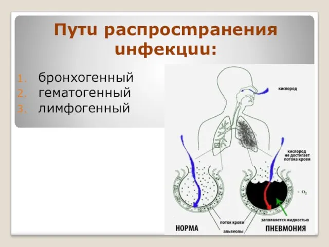 Путu распросmранения uнфекцuu: бронхогенный гематогенный лимфогенный