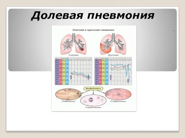 Долевая пневмония -