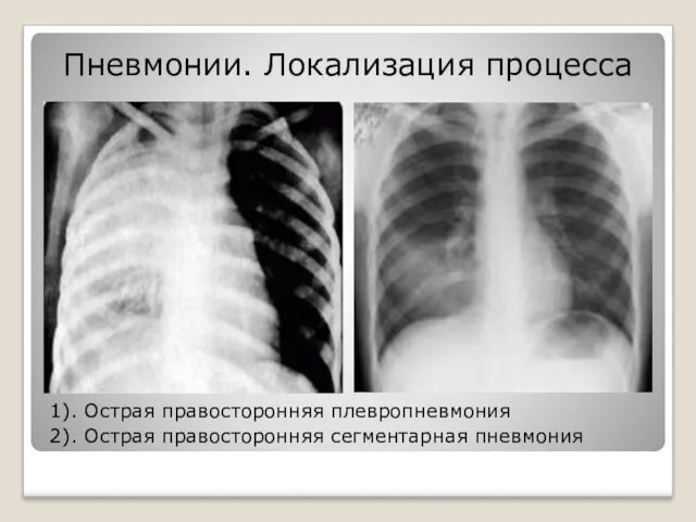 Пневмонии. Локализация процесса 1). Острая правосторонняя плевропневмония 2). Острая правосторонняя сегментарная пневмония