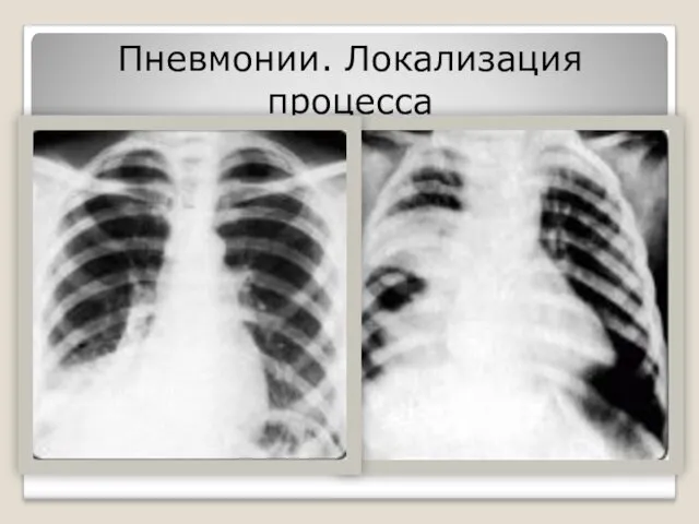 Пневмонии. Локализация процесса