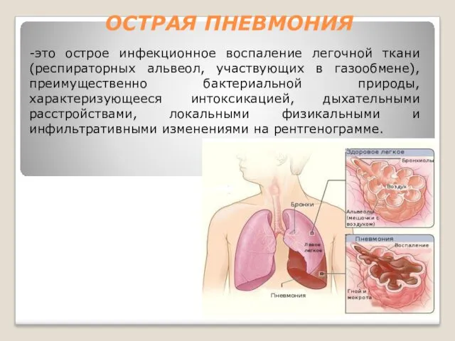 ОСТРАЯ ПНЕВМОНИЯ -это острое инфекционное воспаление легочной ткани (респираторных альвеол, участвующих в газообмене),