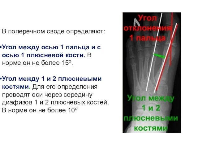 В поперечном своде определяют: Угол между осью 1 пальца и