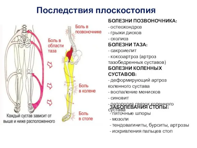 Последствия плоскостопия БОЛЕЗНИ ПОЗВОНОЧНИКА: - остеохондроз - грыжи дисков -