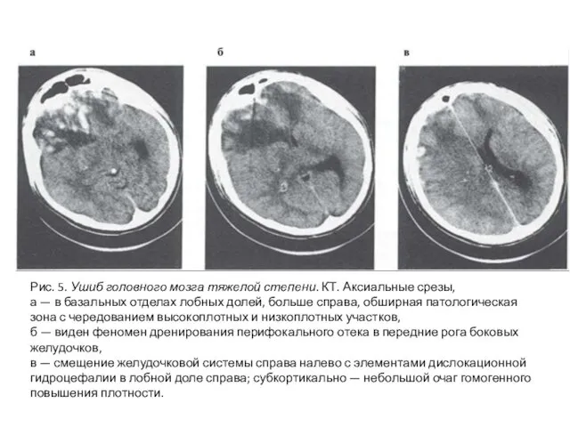 Рис. 5. Ушиб головного мозга тяжелой степени. КТ. Аксиальные срезы,